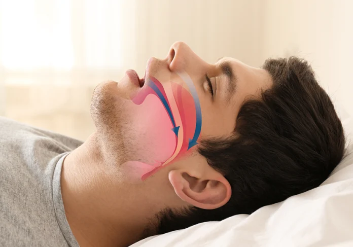 sleep apnea